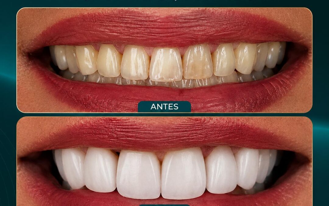 Lente de contato dental no Recreio dos Bandeirantes: saiba como funciona o tratamento