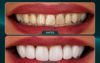 Lente de contato dental no Recreio dos Bandeirantes: saiba como funciona o tratamento