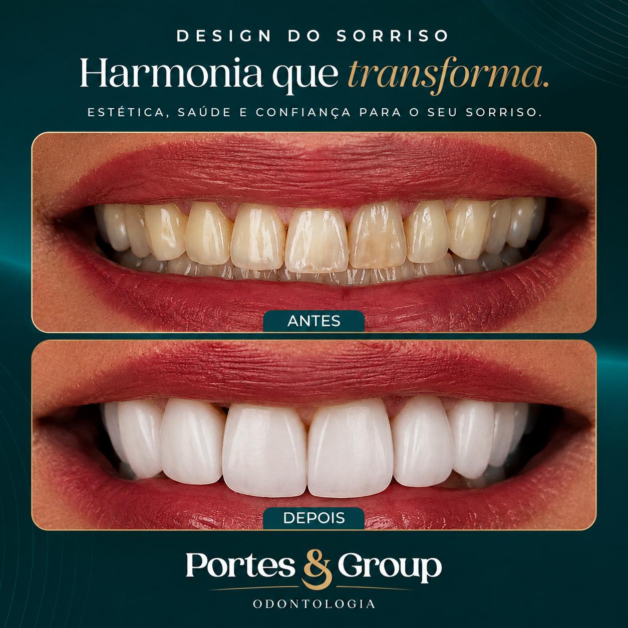 Lente de contato dental na Barra da Tijuca, lentes de contato dental barra da tijuca